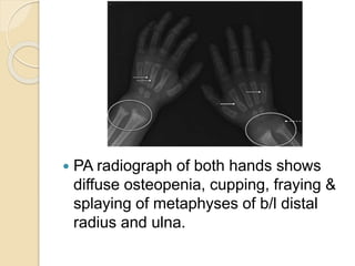  PA radiograph of both hands shows
diffuse osteopenia, cupping, fraying &
splaying of metaphyses of b/l distal
radius and ulna.
 