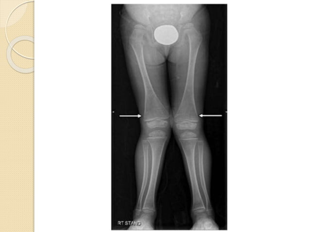 Imaging in Rickets & Scurvy.pptx