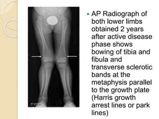  AP Radiograph of
both lower limbs
obtained 2 years
after active disease
phase shows
bowing of tibia and
fibula and
transverse sclerotic
bands at the
metaphysis parallel
to the growth plate
(Harris growth
arrest lines or park
lines)
 