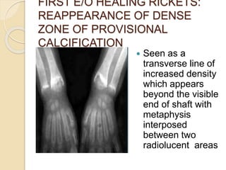 FIRST E/O HEALING RICKETS:
REAPPEARANCE OF DENSE
ZONE OF PROVISIONAL
CALCIFICATION
 Seen as a
transverse line of
increased density
which appears
beyond the visible
end of shaft with
metaphysis
interposed
between two
radiolucent areas
 