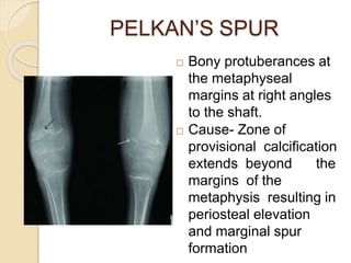 PELKAN’S SPUR
 Bony protuberances at
the metaphyseal
margins at right angles
to the shaft.
 Cause- Zone of
provisional calcification
extends beyond the
margins of the
metaphysis resulting in
periosteal elevation
and marginal spur
formation
 