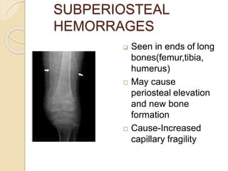 SUBPERIOSTEAL
HEMORRAGES
 Seen in ends of long
bones(femur,tibia,
humerus)
 May cause
periosteal elevation
and new bone
formation
 Cause-Increased
capillary fragility
 
