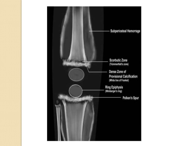 Imaging in Rickets & Scurvy.pptx