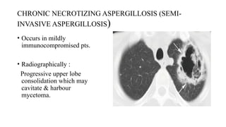 Pbc Radiographically Comprehensive Imaging Techniques in Pulmonary Infections Diagnosis and ...