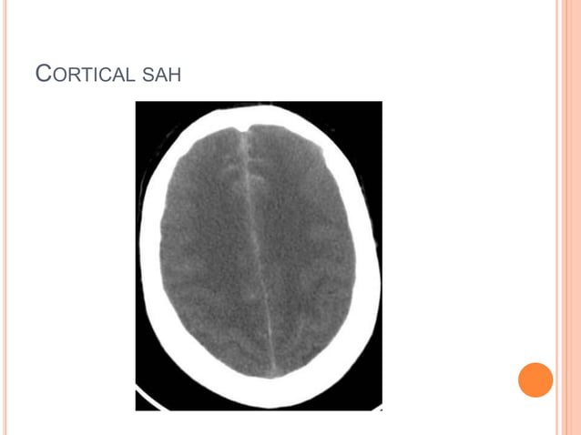 Imaging in SAH | PPTX | Blood Disorders | Diseases and Conditions