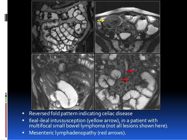 Imaging in small bowel tumors Dr. Muhammad Bin Zulfiqar