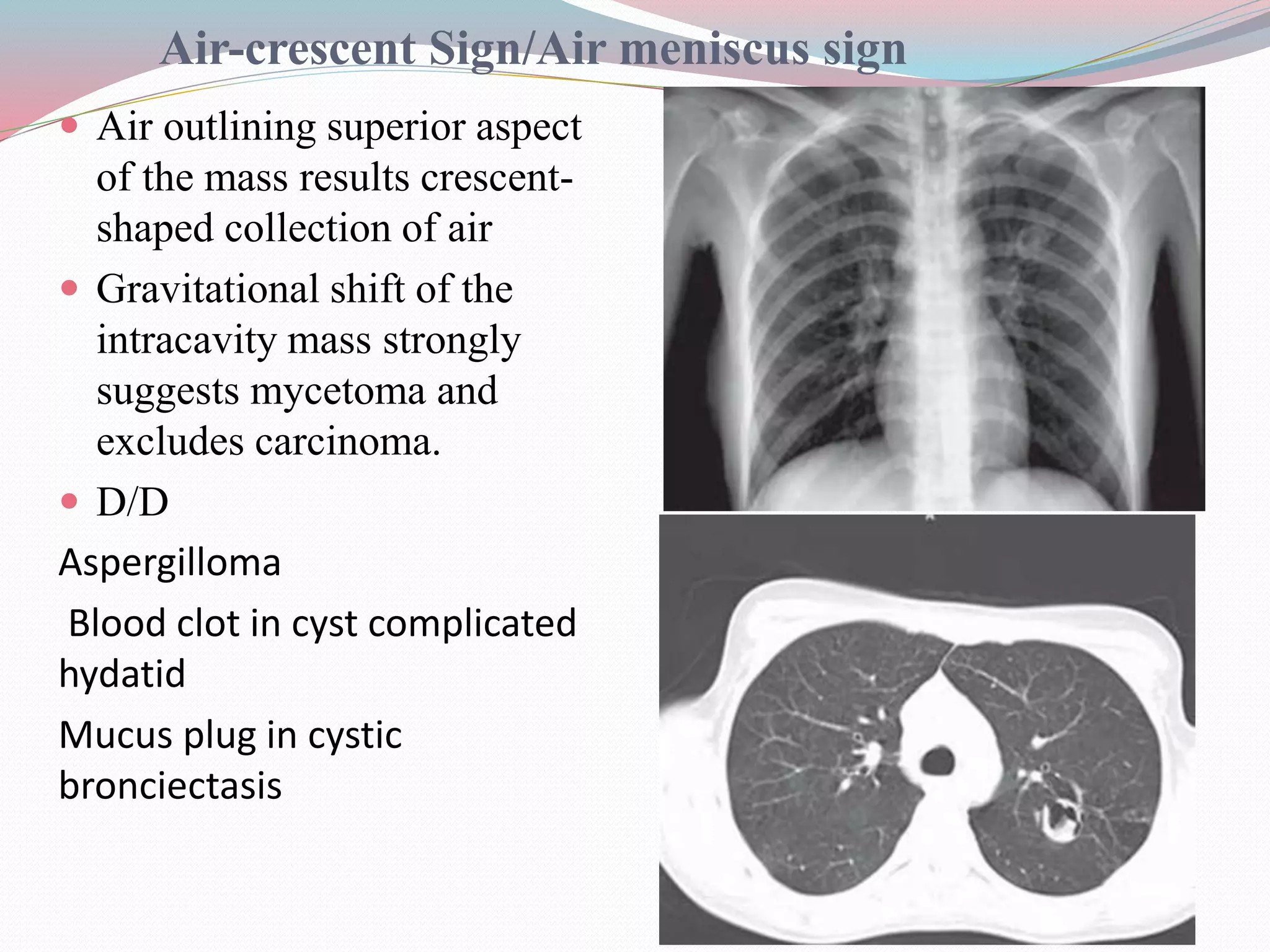 Imaging in solitary pulmonary nodule ppt | PPTX
