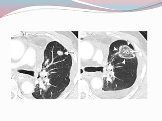 Imaging in solitary pulmonary nodule ppt | PPTX