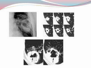 Imaging in solitary pulmonary nodule ppt | PPTX