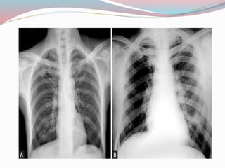 Imaging in solitary pulmonary nodule ppt | PPTX