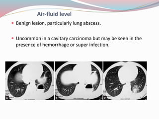 Imaging in solitary pulmonary nodule ppt | PPTX