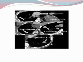 Imaging in solitary pulmonary nodule ppt | PPTX