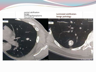 Imaging in solitary pulmonary nodule ppt | PPTX