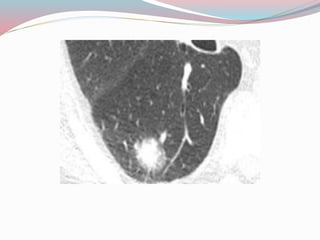 Imaging in solitary pulmonary nodule ppt | PPTX