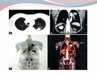 Imaging in solitary pulmonary nodule ppt | PPTX