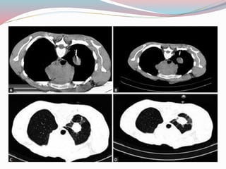 Imaging in solitary pulmonary nodule ppt | PPTX