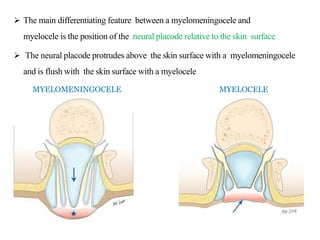  The main differentiating feature between a myelomeningocele and
myelocele is the position of the neural placode relative to the skin surface
 The neural placode protrudes above the skin surface with a myelomeningocele
and is flush with the skin surface with a myelocele
MYELOMENINGOCELE MYELOCELE
 