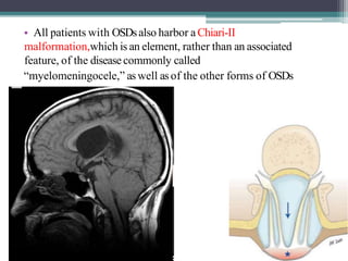 • All patients with OSDsalso harbor a Chiari-II
malformation,which is an element, rather than an associated
feature, of the diseasecommonly called
“myelomeningocele,” aswell asof the other forms of OSDs
 