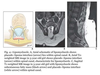 Fig. 4—Lipomyelocele. A, Axial schematic of lipomyelocele shows
placode–lipoma interface (arrow) lies within spinal canal. B, Axial T2-
weighted MR image in 3-year-old girl shows placode–lipoma interface
(arrow) within spinal canal, characteristic for lipomyelocele. C, Sagittal
T1-weighted MR image in 3-year-old girl with lipomyelocele shows
subcutaneous fatty mass (black arrow) and placode–lipoma interface
(white arrow) within spinal canal.
 