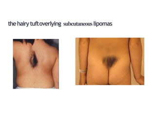 thehairytuftoverlying subcutaneouslipomas
 