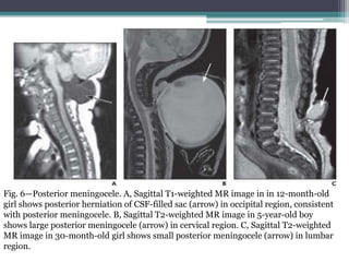 Fig. 6—Posterior meningocele. A, Sagittal T1-weighted MR image in in 12-month-old
girl shows posterior herniation of CSF-filled sac (arrow) in occipital region, consistent
with posterior meningocele. B, Sagittal T2-weighted MR image in 5-year-old boy
shows large posterior meningocele (arrow) in cervical region. C, Sagittal T2-weighted
MR image in 30-month-old girl shows small posterior meningocele (arrow) in lumbar
region.
 