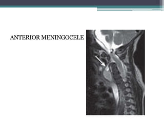 ANTERIOR MENINGOCELE
 