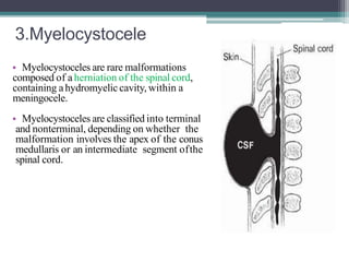 3.Myelocystocele
• Myelocystoceles are rare malformations
composed of a herniation of the spinal cord,
containing ahydromyelic cavity, within a
meningocele.
• Myelocystoceles are classified into terminal
and nonterminal, depending on whether the
malformation involves the apex of the conus
medullaris or an intermediate segment ofthe
spinal cord.
 