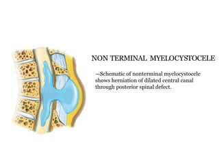 NON TERMINAL MYELOCYSTOCELE
—Schematic of nonterminal myelocystocele
shows herniation of dilated central canal
through posterior spinal defect.
 