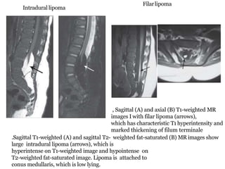 Intradural lipoma
Filarlipoma
, Sagittal (A) and axial (B) T1-weighted MR
images I with filar lipoma (arrows),
which has characteristic T1 hyperintensity and
marked thickening of filum terminale
.Sagittal T1-weighted (A) and sagittal T2- weighted fat-saturated (B) MR images show
large intradural lipoma (arrows), which is
hyperintense on T1-weighted image and hypointense on
T2-weighted fat-saturated image. Lipoma is attached to
conus medullaris, which is low lying.
 