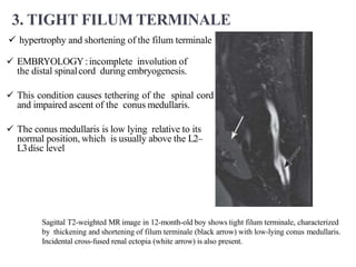 3. TIGHT FILUM TERMINALE
 hypertrophy and shortening of the filum terminale
 EMBRYOLOGY:incomplete involution of
the distal spinalcord during embryogenesis.
 This condition causes tethering of the spinal cord
and impaired ascent of the conus medullaris.
 The conus medullaris is low lying relative to its
normal position, which is usually above the L2–
L3disc level
Sagittal T2-weighted MR image in 12-month-old boy shows tight filum terminale, characterized
by thickening and shortening of filum terminale (black arrow) with low-lying conus medullaris.
Incidental cross-fused renal ectopia (white arrow) is also present.
 