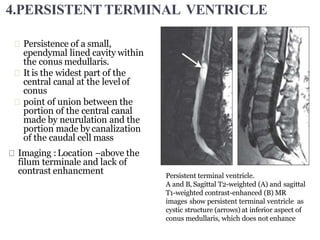 Persistence of a small,
ependymal lined cavity within
the conus medullaris.
It is the widest part of the
central canal at the levelof
conus
point of union between the
portion of the central canal
made by neurulation and the
portion made by canalization
of the caudal cell mass
Imaging :Location –above the
filum terminale and lack of
contrast enhancment Persistent terminal ventricle.
A and B, Sagittal T2-weighted (A) and sagittal
T1-weighted contrast-enhanced (B) MR
images show persistent terminal ventricle as
cystic structure (arrows) at inferior aspect of
conus medullaris, which does not enhance
4.PERSISTENTTERMINAL VENTRICLE
 