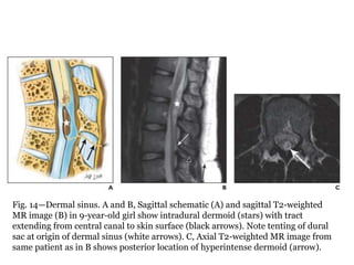 Fig. 14—Dermal sinus. A and B, Sagittal schematic (A) and sagittal T2-weighted
MR image (B) in 9-year-old girl show intradural dermoid (stars) with tract
extending from central canal to skin surface (black arrows). Note tenting of dural
sac at origin of dermal sinus (white arrows). C, Axial T2-weighted MR image from
same patient as in B shows posterior location of hyperintense dermoid (arrow).
 