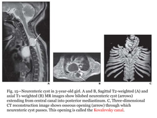 Fig. 15—Neurenteric cyst in 3-year-old girl. A and B, Sagittal T2-weighted (A) and
axial T1-weighted (B) MR images show bilobed neurenteric cyst (arrows)
extending from central canal into posterior mediastinum. C, Three-dimensional
CT reconstruction image shows osseous opening (arrow) through which
neurenteric cyst passes. This opening is called the Kovalevsky canal.
 