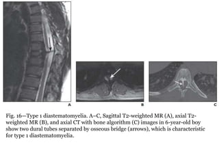 Fig. 16—Type 1 diastematomyelia. A–C, Sagittal T2-weighted MR (A), axial T2-
weighted MR (B), and axial CT with bone algorithm (C) images in 6-year-old boy
show two dural tubes separated by osseous bridge (arrows), which is characteristic
for type 1 diastematomyelia.
 