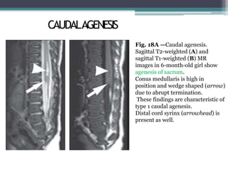 CAUDALAGENESIS
,
Fig. 18A —Caudal agenesis.
Sagittal T2-weighted (A) and
sagittal T1-weighted (B) MR
images in 6-month-old girl show
agenesis of sacrum.
Conus medullaris is high in
position and wedge shaped (arrow)
due to abrupt termination.
These findings are characteristic of
type 1 caudal agenesis.
Distal cord syrinx (arrowhead) is
present as well.
 
