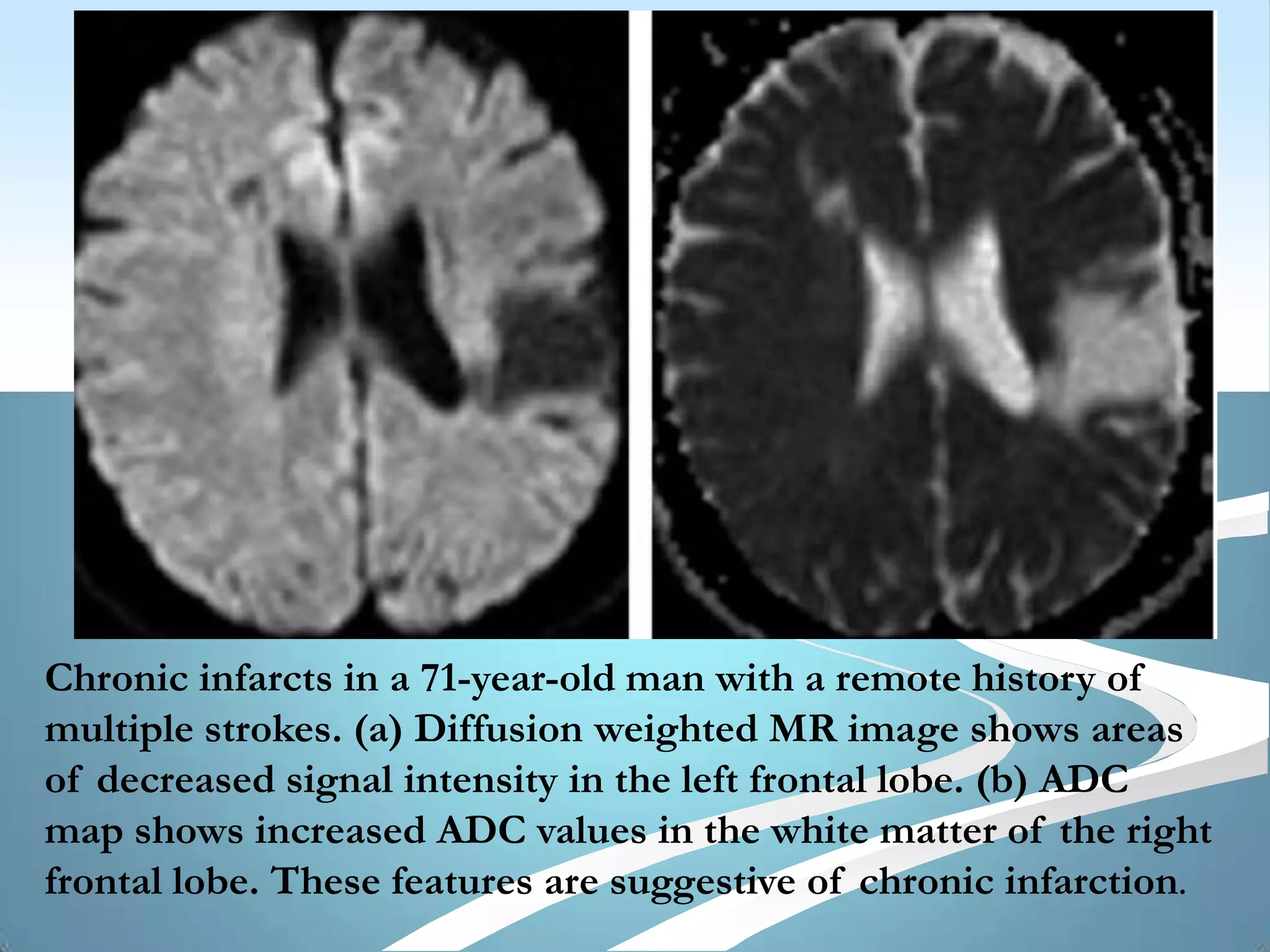 Imaging in stroke | PPTX