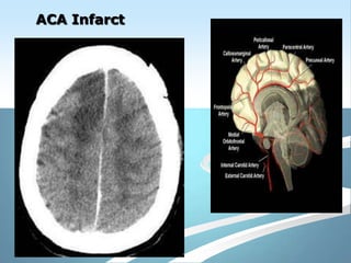 Imaging in stroke | PPTX