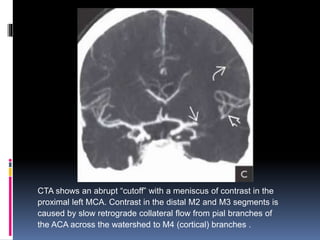 CTA shows an abrupt “cutoff” with a meniscus of contrast in the
proximal left MCA. Contrast in the distal M2 and M3 segments is
caused by slow retrograde collateral flow from pial branches of
the ACA across the watershed to M4 (cortical) branches .
 