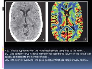 NECT shows hypodensity of the right basal ganglia compared to the normal.
pCT was performed CBV shows markedly reduced blood volume in the right basal
ganglia compared to the normal left side .
CBV in the cortex overlying the basal ganglia infarct appears relatively normal.
 