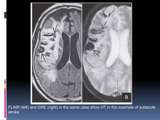 FLAIR (left) and GRE (right) in the same case show HT in this example of subacute
stroke
 