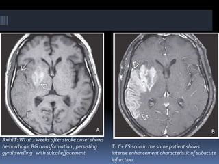 AxialT1WI at 2 weeks after stroke onset shows
hemorrhagic BG transformation , persisting
gyral swelling with sulcal effacement
T1 C+ FS scan in the same patient shows
intense enhancement characteristic of subacute
infarction
 