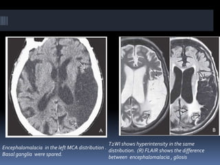 Encephalomalacia in the left MCA distribution .
Basal ganglia were spared.
T2WI shows hyperintensity in the same
distribution. (R) FLAIR shows the difference
between encephalomalacia , gliosis
 