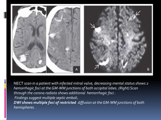 NECT scan in a patient with infected mitral valve, decreasing mental status shows 2
hemorrhagic foci at the GM-WM junctions of both occipital lobes. (Right) Scan
through the corona radiata shows additional hemorrhagic foci .
Findings suggest multiple septic emboli.
DWI shows multiple foci of restricted diffusion at the GM-WM junctions of both
hemispheres.
 