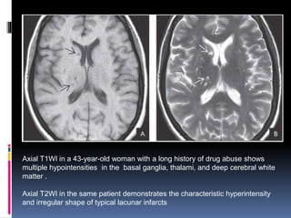 Axial T1WI in a 43-year-old woman with a long history of drug abuse shows
multiple hypointensities in the basal ganglia, thalami, and deep cerebral white
matter .
Axial T2WI in the same patient demonstrates the characteristic hyperintensity
and irregular shape of typical lacunar infarcts
 
