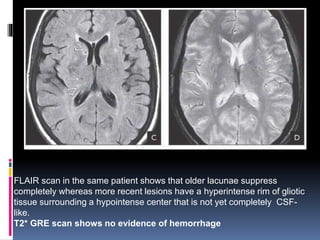 FLAIR scan in the same patient shows that older lacunae suppress
completely whereas more recent lesions have a hyperintense rim of gliotic
tissue surrounding a hypointense center that is not yet completely CSF-
like.
T2* GRE scan shows no evidence of hemorrhage
 