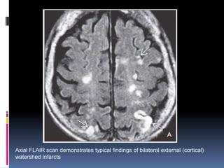 Axial FLAIR scan demonstrates typical findings of bilateral external (cortical)
watershed infarcts
 