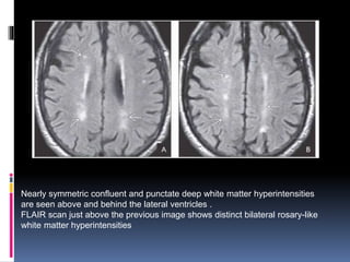 Nearly symmetric confluent and punctate deep white matter hyperintensities
are seen above and behind the lateral ventricles .
FLAIR scan just above the previous image shows distinct bilateral rosary-like
white matter hyperintensities
 