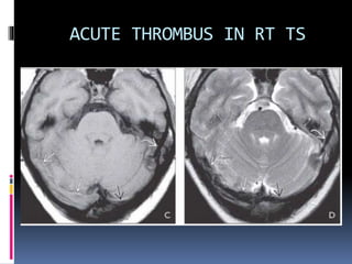 ACUTE THROMBUS IN RT TS
 