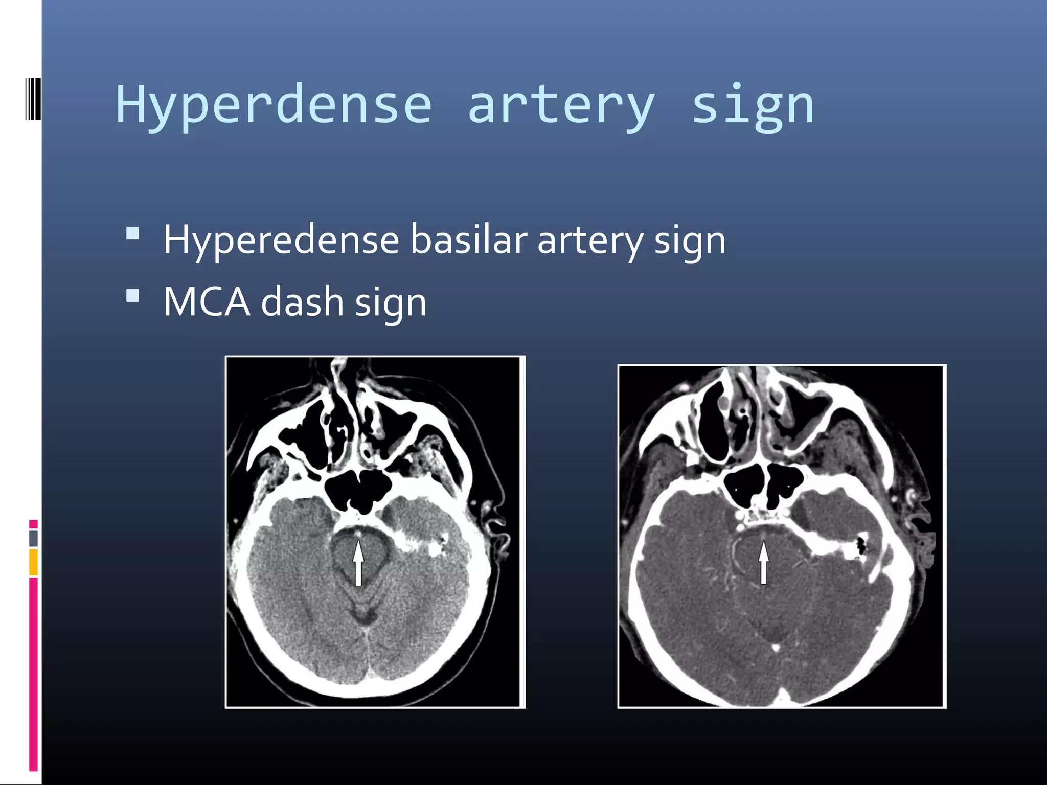 Hyperdense artery sign
 Hyperedense basilar artery sign
 MCA dash sign
 