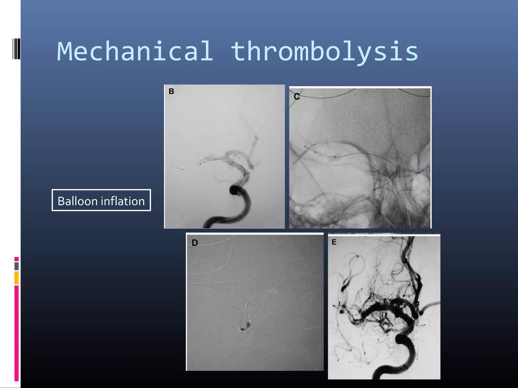Mechanical thrombolysis
Balloon inflation
 
